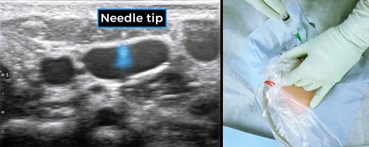 Pediatric Ultrasound-Guided Internal Jugular Central Venous Catheter (CVC) Insertion for Chemotherapy Delivery