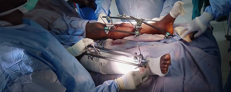 Debridement and External Fixation for Bilateral Neglected Open Tibial Shaft Fractures