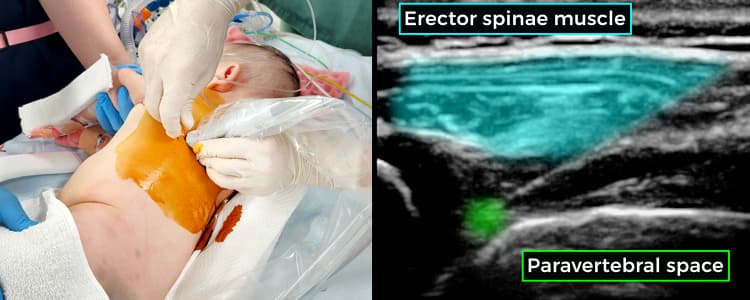 Ultrasound-Guided Paravertebral Block in an Infant