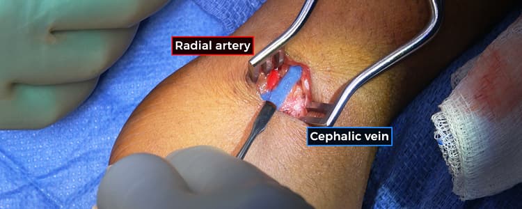 Snuffbox Radiocephalic Arteriovenous Fistula Creation for End-Stage Kidney Disease