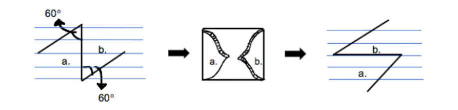 El procedimiento Z-Plasty se muestra con la transposición de los dos colgajos. La línea inicial es perpendicular a las líneas