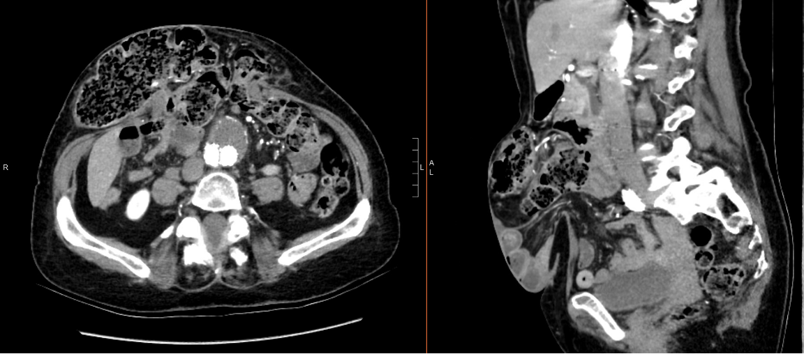 The axial plane (left) and sagittal plane (right) of the CT scan show prior right colectomy and previous endovascular repair 