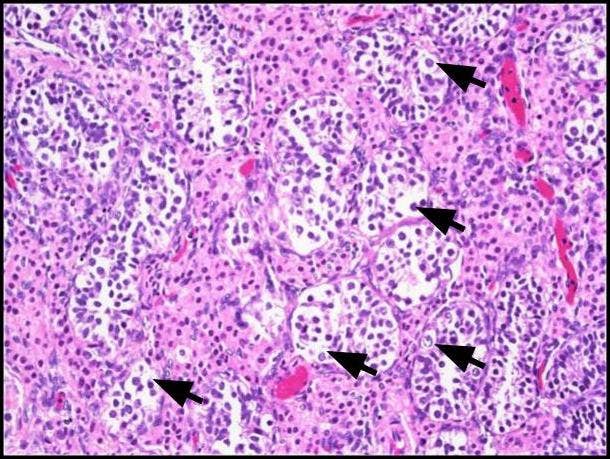 et al.et al.et al.et al.et al.et al.et al.et al.et al.et al.Germ cell neoplasia in situ (GCNIS). Large atypical cells (black 