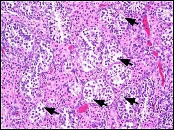 एट अलet al.एट अल नेएट अल नेएट अल नेet al.et al.et al.एट अल नेएट अलरोगाणु कोशिका नियोप्लासिया इन सीटू (GCNIS)। बड़ी एटिपिकल को