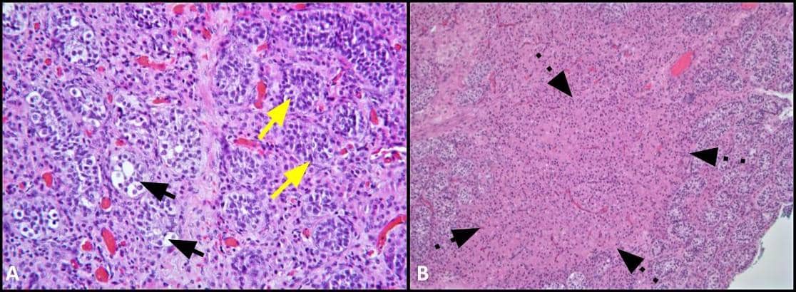 et alet alet alet al.et alet alet al.et alet al.Keimzellneoplasie in situ (GCNIS). Große atypische Zellen (schwarze Pfeile) m