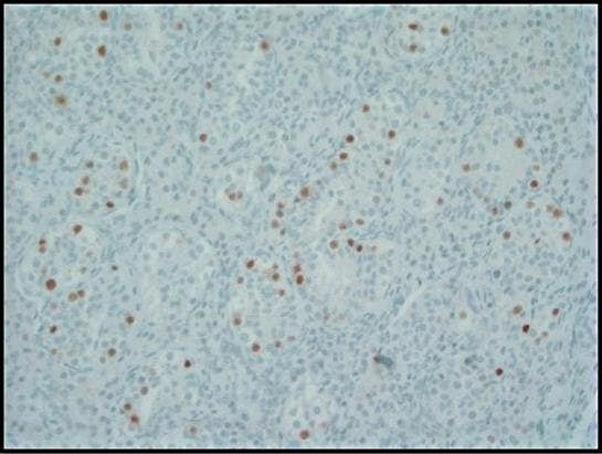 et alet alet alet al.et alet alet al.et alet al.Keimzellneoplasie in situ (GCNIS). Große atypische Zellen (schwarze Pfeile) m