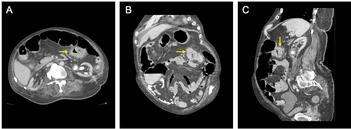 복부와 골반의 CT 스캔을 정맥 및 구강 조영제로 스캔하여 가로 결장 덩어리가 막히는 증거를 보여줍니다. 병든 조직은 (A) 축 방향, (B) 관상 동맥 및 (C) 시상도를 나타냅니다. 노란색 화살표는 결장의 병든 부분을 가