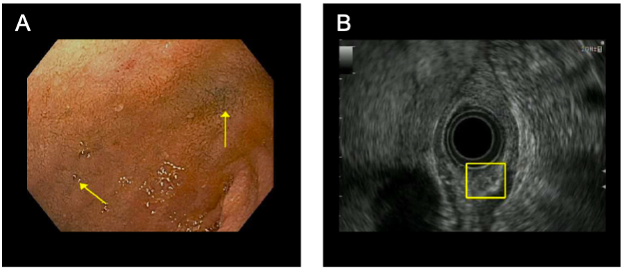 (A) Endoscopic image of duodenum. Yellow arrows point to blue ink tattoo from prior endoscopic marking of the mass. The lesio