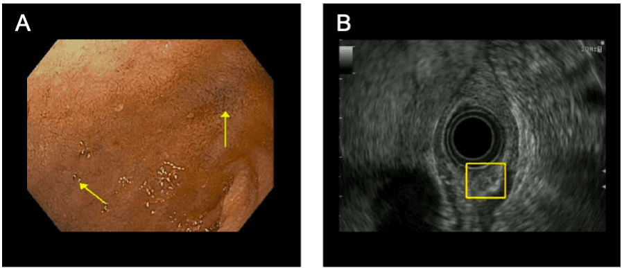 (A) Endoscopic image of duodenum. Yellow arrows point to blue ink tattoo from prior endoscopic marking of the mass. The lesio