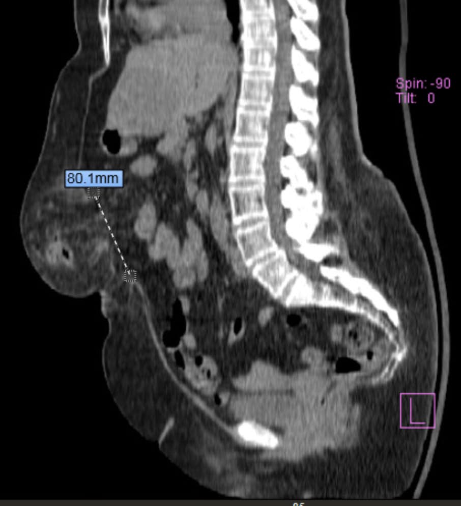 CT preop sagittal (1).jpg