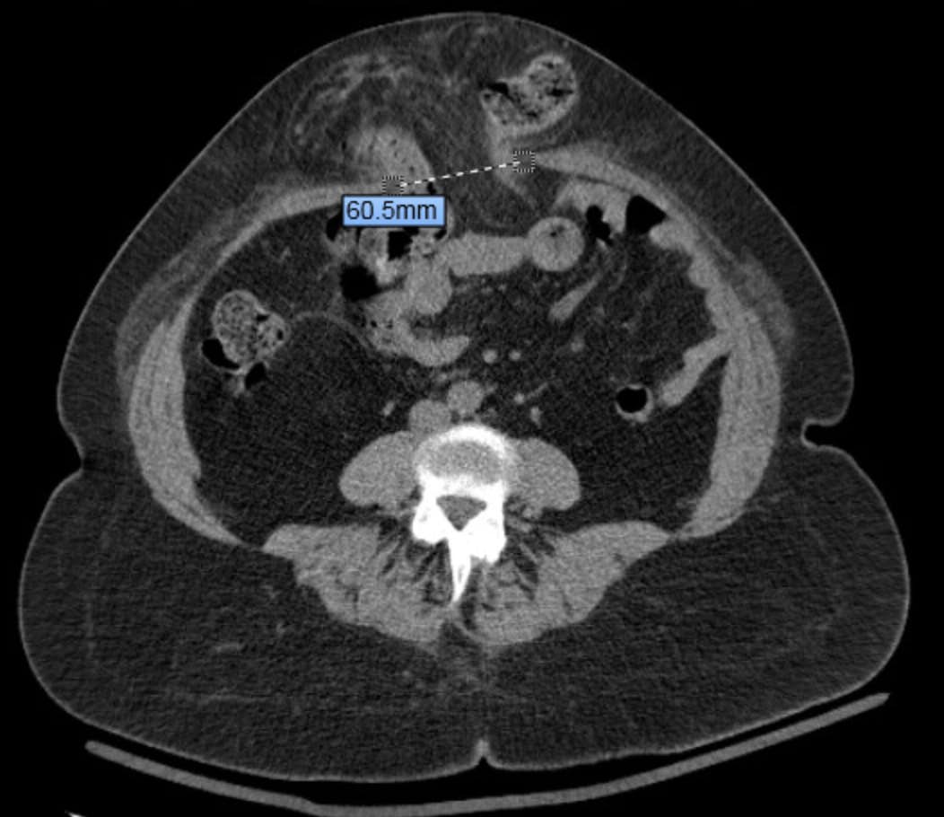 CT preop xsection (1).jpg