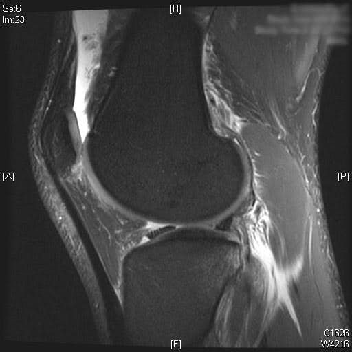ACL MRI Lateral Menisus Tear 1