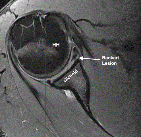 Axial magnetic resonance imaging showing a Bankart lesion in a left shoulder.