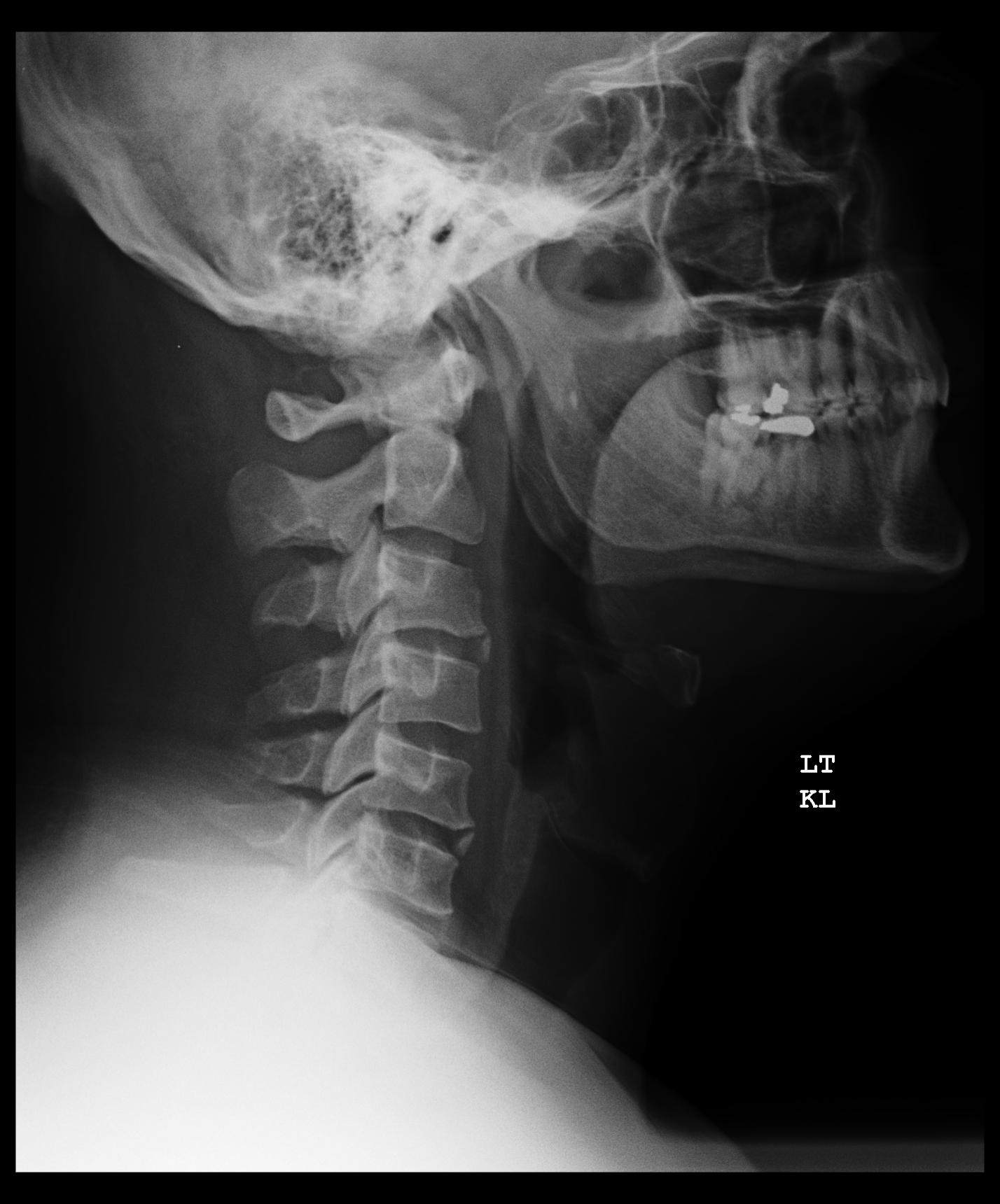 Lateral C-spine