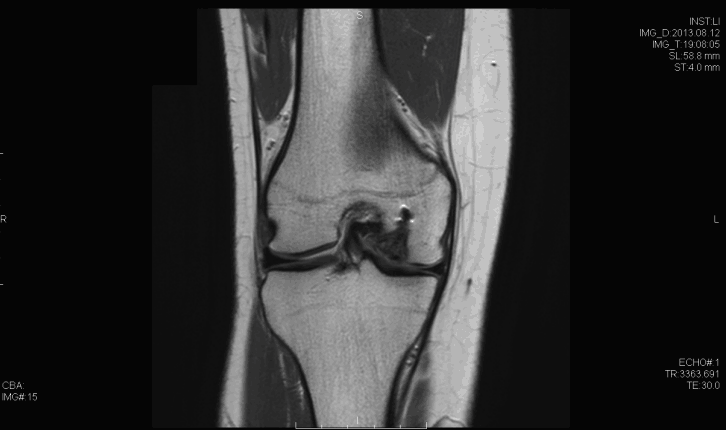 Coronal T1 Magnetic resonance imaging demonstrating osteochondral defect