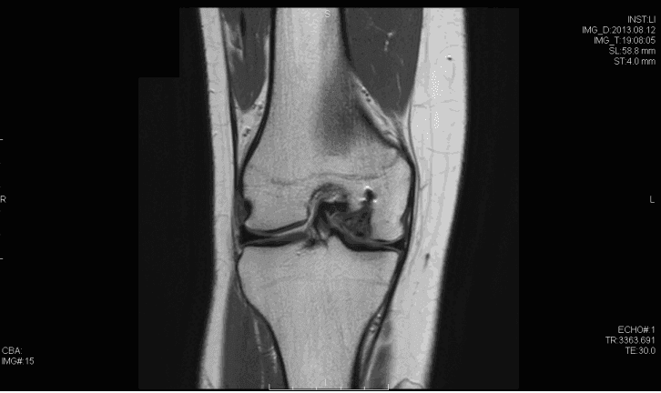 골연골 결함을 보여주는 Coronal T1 자기 공명 영상