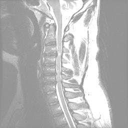 Columna vertebral T2 Sagital