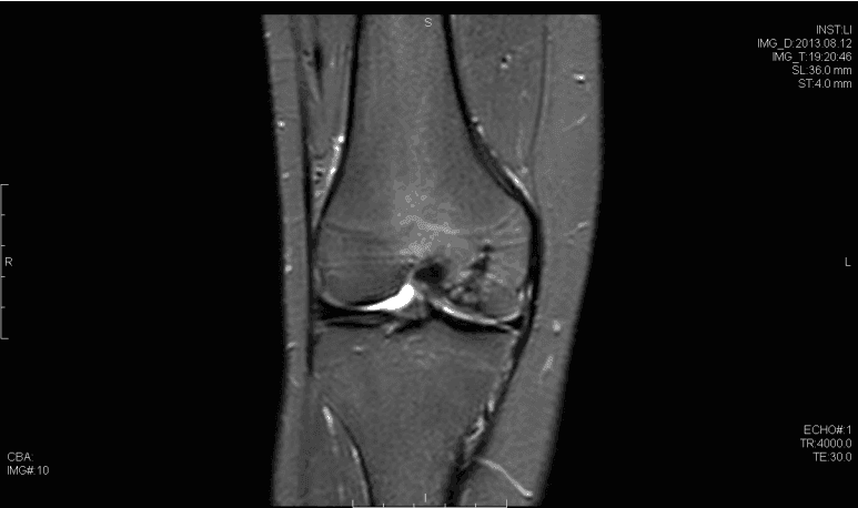 STIR चुंबकीय अनुनाद इमेजिंग osteochondral दोष का प्रदर्शन