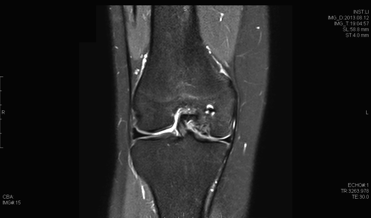 Coronal T2 Magnetic resonance imaging demonstrating osteochondral defect