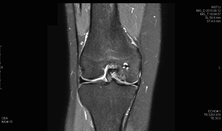 Koronale T2-Magnetresonanztomographie zeigt osteochondralen Defekt