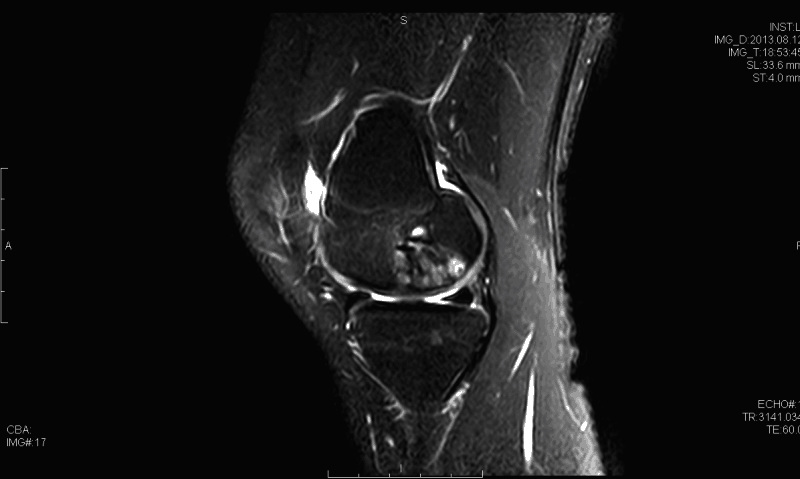 Sagittal T2 Magnetresonanztomographie zeigt osteochondralen Defekt
