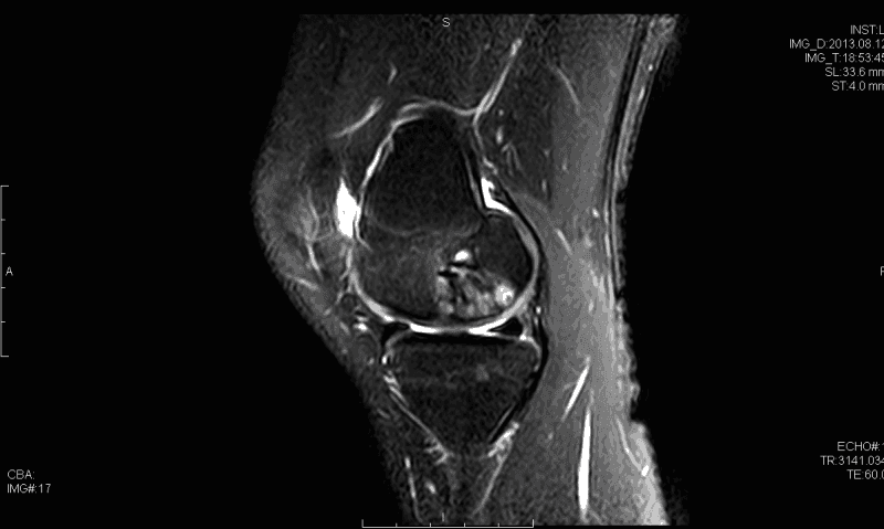 Resonancia magnética T2 sagital que demuestra defecto osteocondral