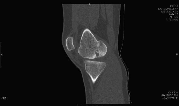 Sagittal computed tomography imaging demonstrating bony aspect of the defect