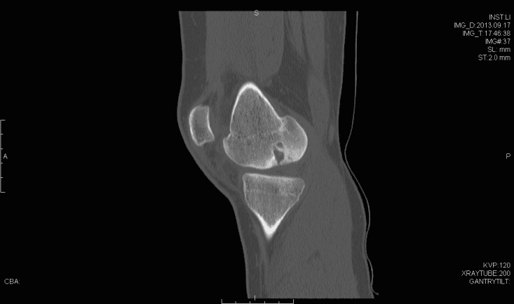 Sagittal computed tomography imaging demonstrating bony aspect of the defect