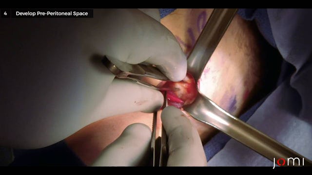 Minimally Invasive Open Preperitoneal Inguinal Hernia Repair