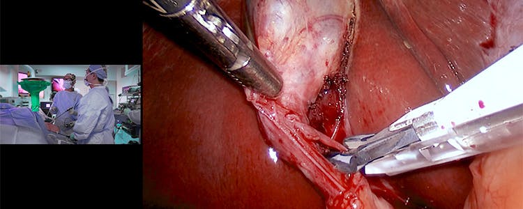 Laparoscopic-Cholecystectomy
