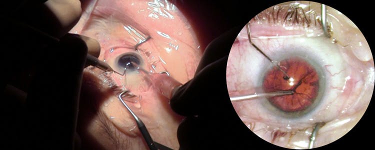 cataract-extraction-with-phacoemulsification-and-posterior-chamber-intraocular-lens
