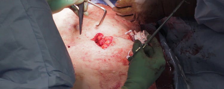 open-left-colectomy-for-colon-cancer:-left-colon-and-sigmoid-resection-with-colostomy-formation