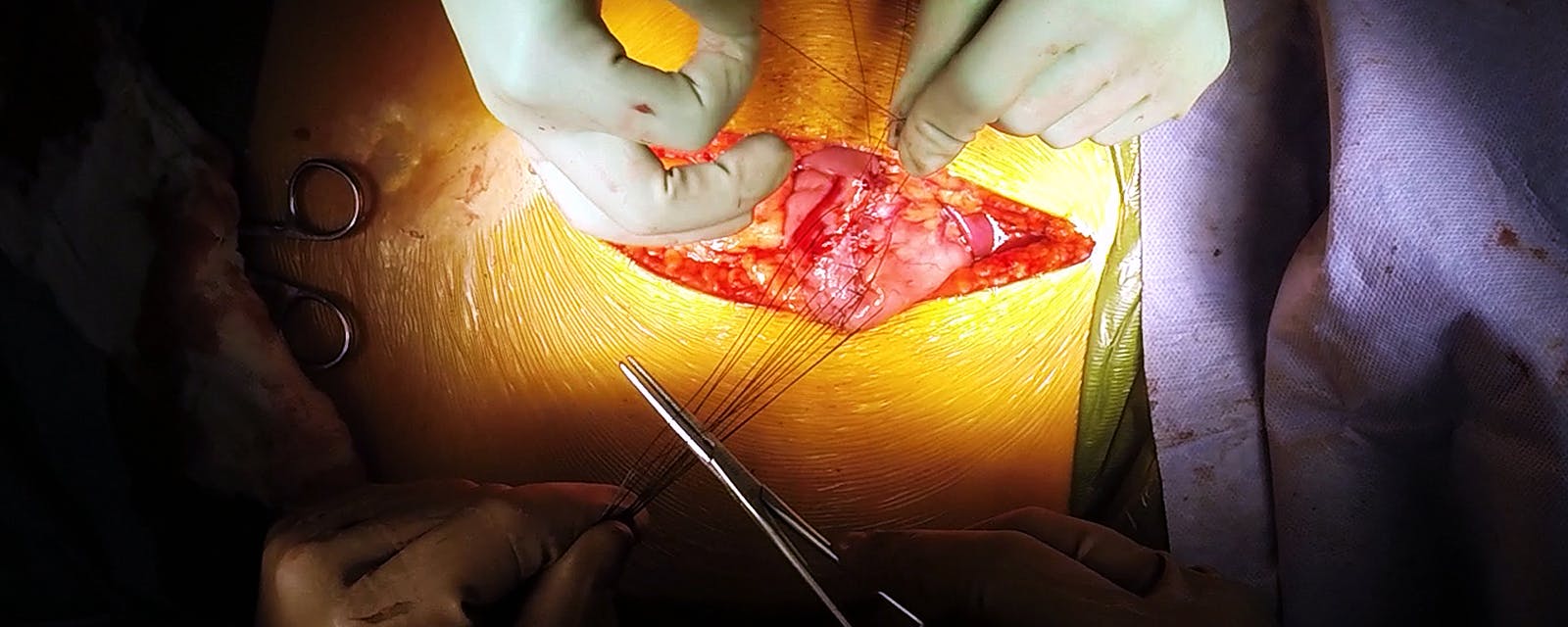open-antrectomy-gastrojejunostomy-multiple-endocrine-neoplasia-tumor