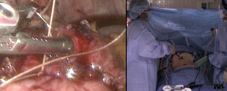 laparoscopic-gastric-bypass-revision