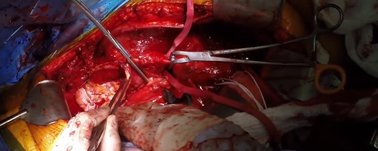 thoracoabdominal-aortic-aneurysm-repair-part-1