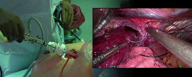 laparoscopic-paraesophageal-hernia-repair