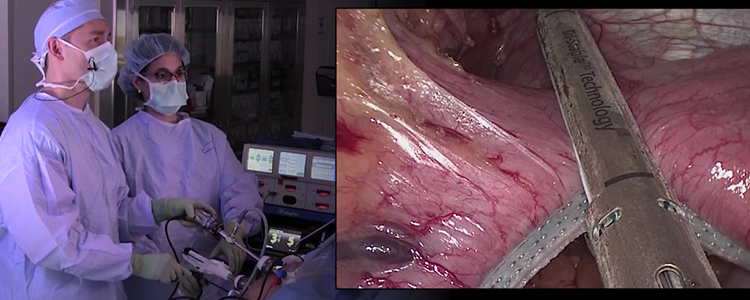 laparoscopic-sleeve-gastrectomy