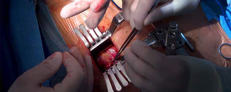 minimally-invasive-direct-coronary-artery-bypass