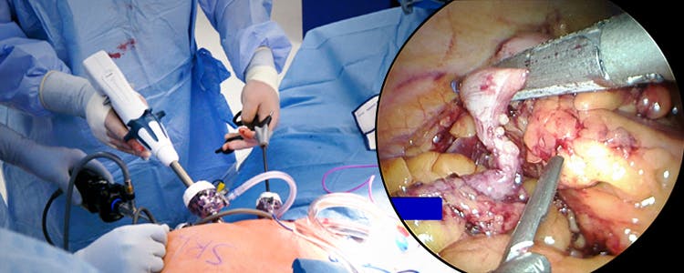 laparoscopic-cecal-wedge-resection-appendectomy