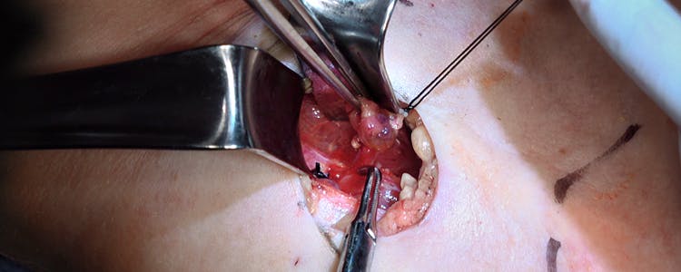 minimally-invasive-parathyroidectomy-under-local-cervical-block-anesthesia-for-primary-hyperparathyroidism-and-parathyroid-adenoma