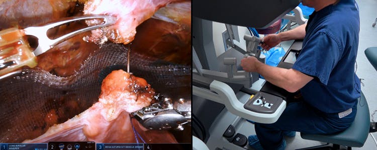 Robotic-Assisted-Laparoscopic-(rTAPP)-Bilateral-Inguinal-Hernia-Repair