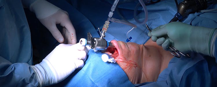 Trans-Oral-Endoscopic-Thyroidectomy-Vestibular-Approach-(TOETVA)
