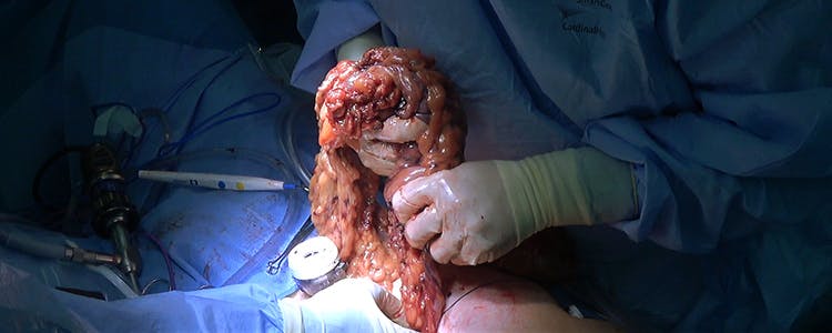 laparoscopic-total-abdominal-colectomy-with-ileorectal-anastomosis-for-crohn's-colitis-and-multifocal-dysplasia