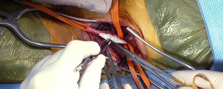 Carotid-Endarterectomy-(Cadaver)