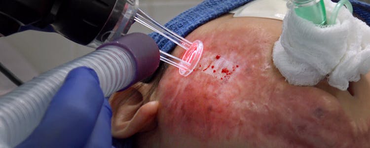 Pulsed-Dye-and-Fractional-CO2-Laser-Therapy-for-Treatment-of-Burn-Scars