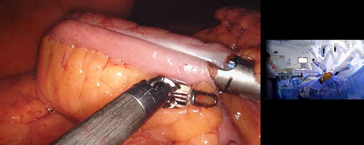 Robotic-Right-Hemicolectomy-for-Tubulovillous-Adenoma-with-High-Grade-Dysplasia:-Multimedia-Analysis-of-a-Contemporary-Technique