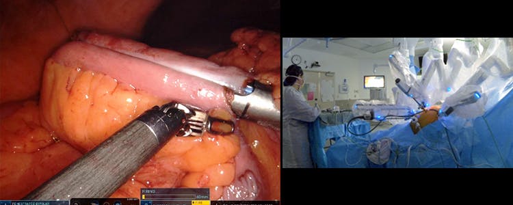 robotic-right-hemicolectomy-for-tubulovillous-adenoma-with-high-grade-dysplasia:-multimedia-analysis-of-a-contemporary-technique