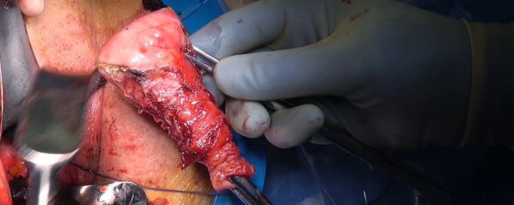vaginal-hysterectomy-uterosacral-ligament-suspension-anterior-repair-and-perineorrhaphy