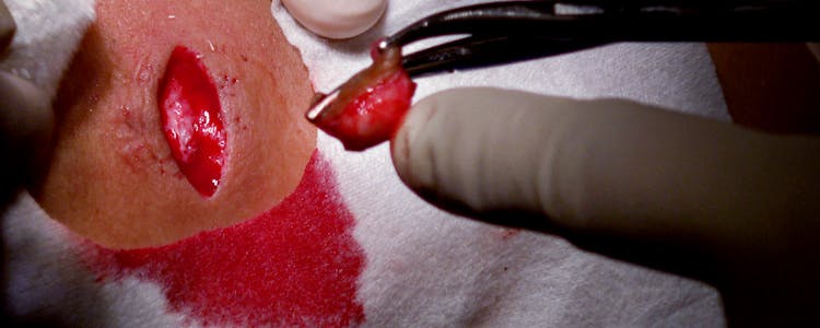 Excision-of-Epidermal-Inclusion-Cyst