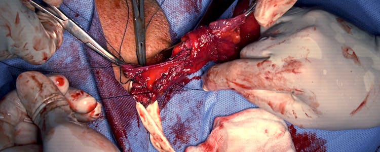 Right-Open-Indirect-Inguinal-Hernia-Repair-and-Radical-Inguinal-Orchiectomy